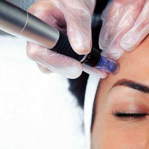 Close up of woman getting microneedling treatment