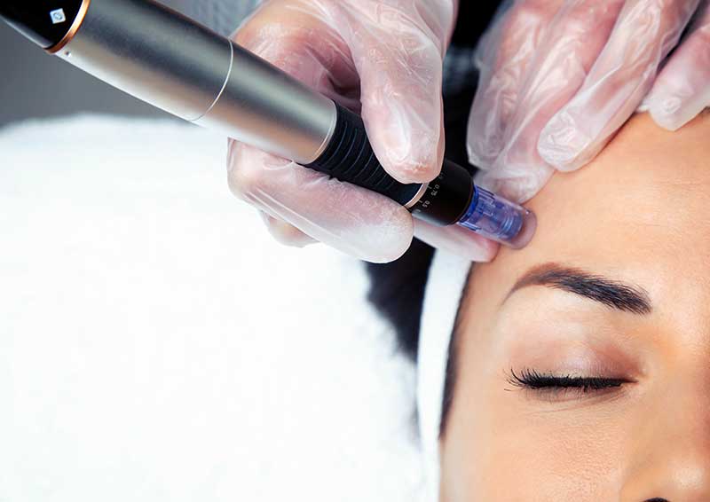 Woman getting microneedling treatment