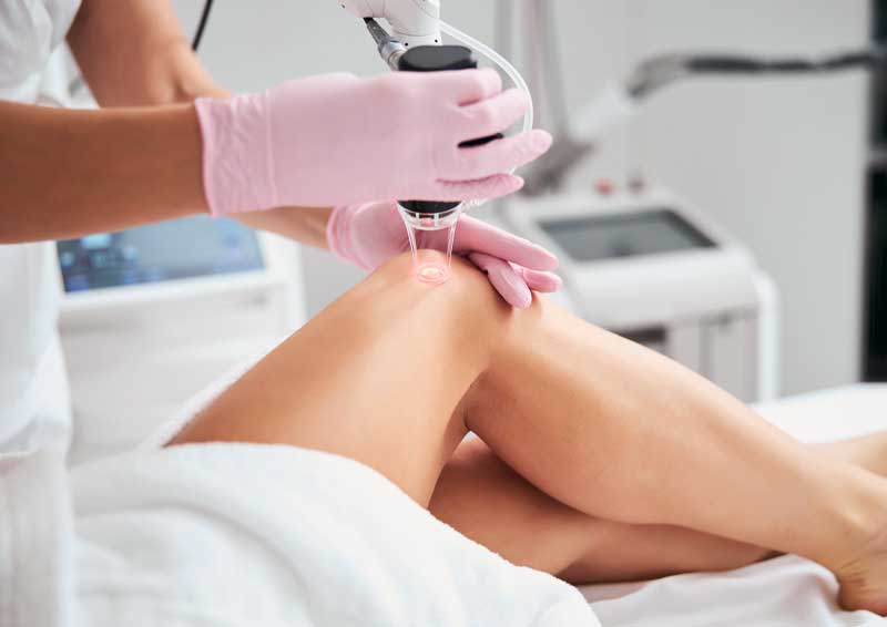 Woman gets treatment on legs for spider veins