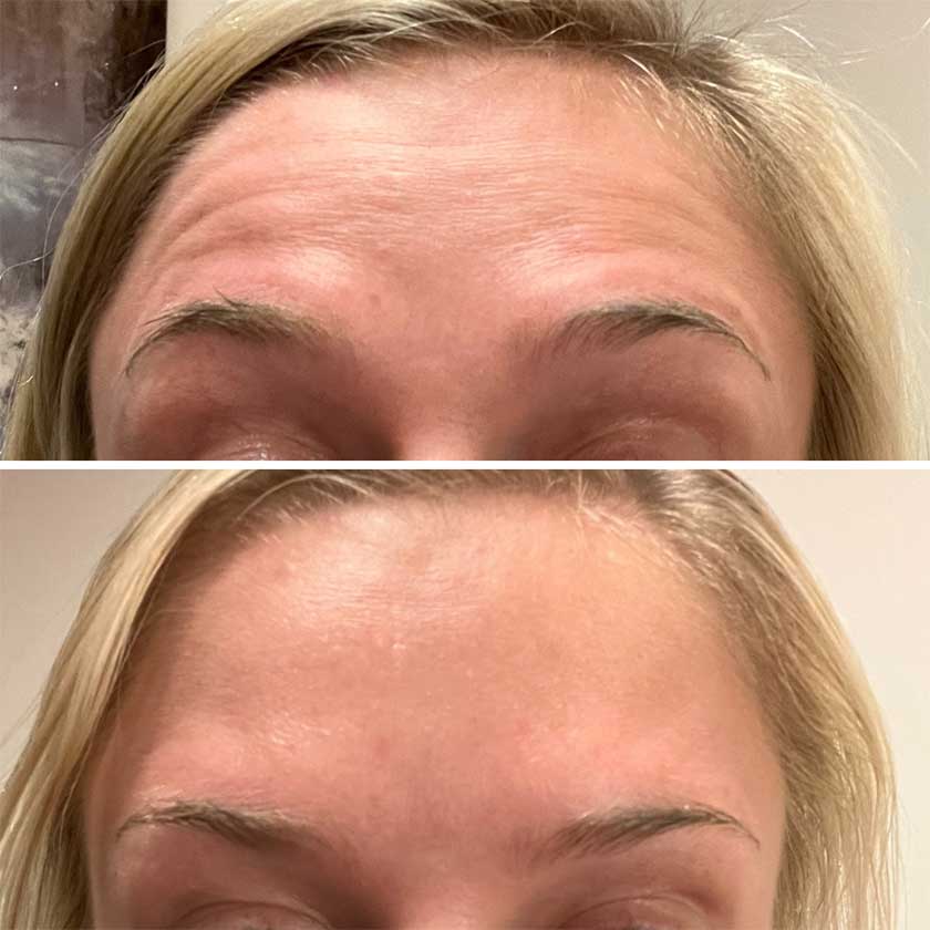 Denver Skin Care Clinic and Medical Spa Before & After Gallery Botox Before and After 1