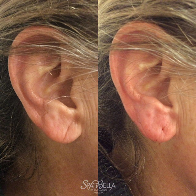 Denver Skin Care Clinic and Medical Spa Before & After Gallery Earlobe Vollure 1