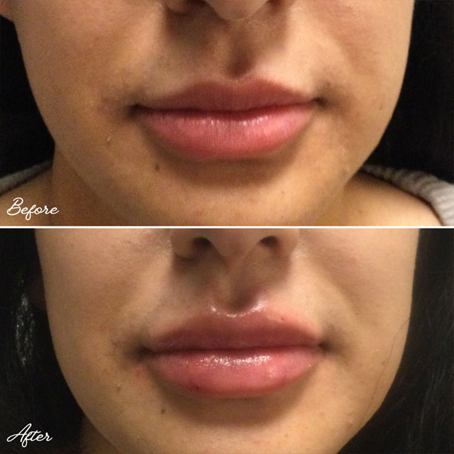 Denver Skin Care Clinic and Medical Spa Before & After Gallery Juvederm Lips 1