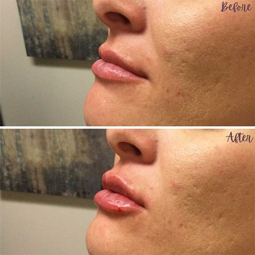 Denver Skin Care Clinic and Medical Spa Before & After Gallery Juvederm ba 3