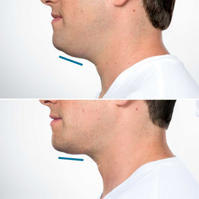 Denver Skin Care Clinic and Medical Spa Before & After Gallery Kybella Before and After 2