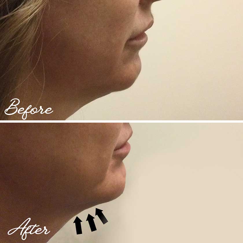 Denver Skin Care Clinic and Medical Spa Before & After Gallery Kybella Before and After