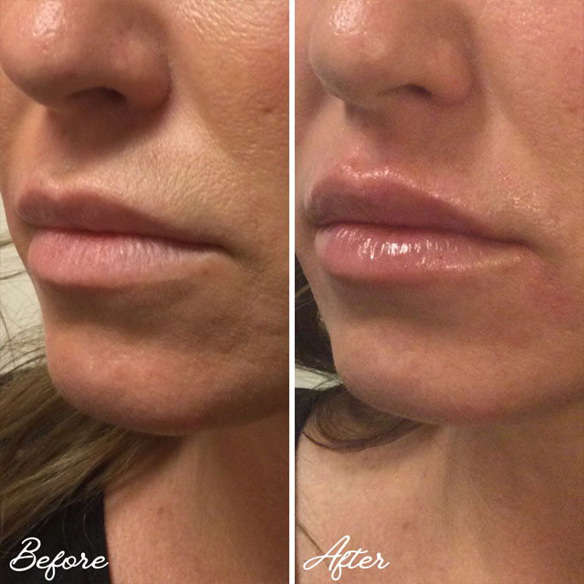 Denver Skin Care Clinic and Medical Spa Before & After Gallery Volbella Before and After 2