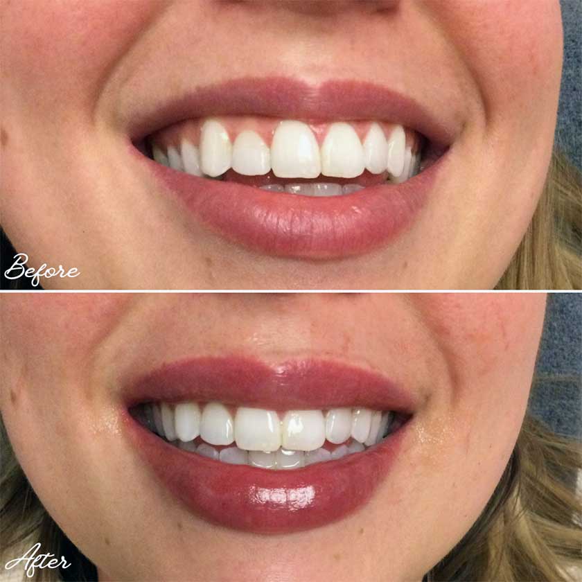 Denver Skin Care Clinic and Medical Spa Before & After Gallery Volbella Lip Filler 1