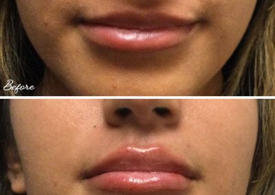 Vollure Lips Before & After