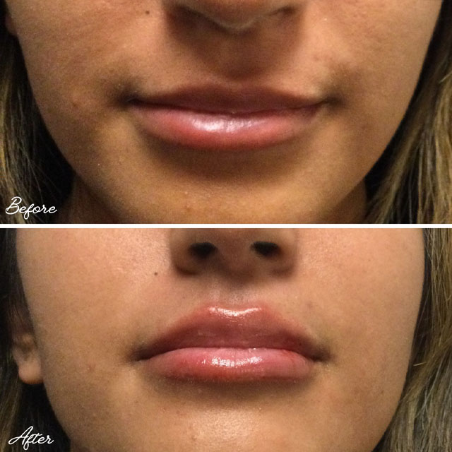 Denver Skin Care Clinic and Medical Spa Before & After Gallery Vollure Lip Filler 1A