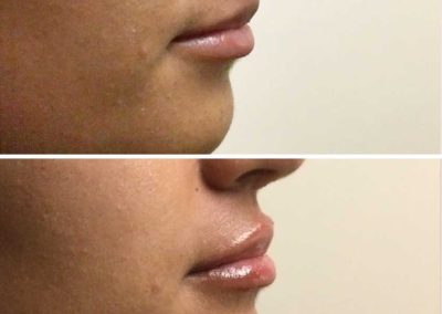 Vollure Before & After