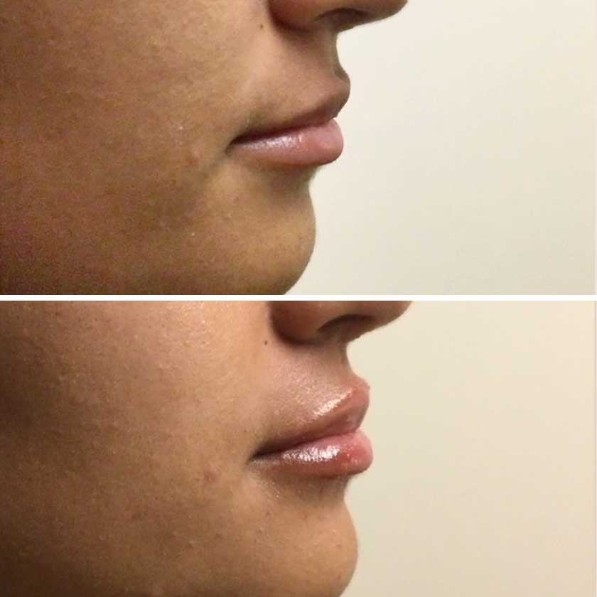 Denver Skin Care Clinic and Medical Spa Before & After Gallery Vollure Lip Filler 2
