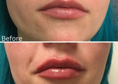 Vollure Lips Before & After