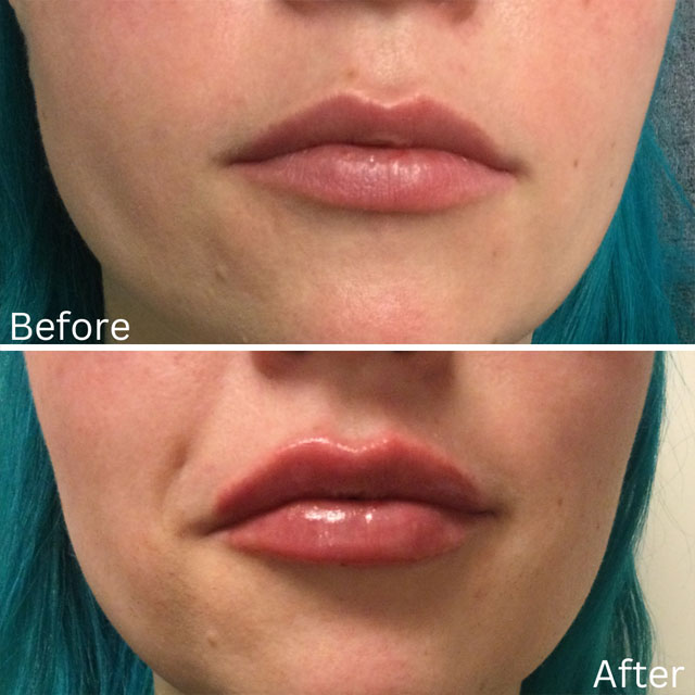 Denver Skin Care Clinic and Medical Spa Before & After Gallery Vollure Lips 1