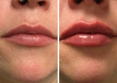 Vollure Before & After