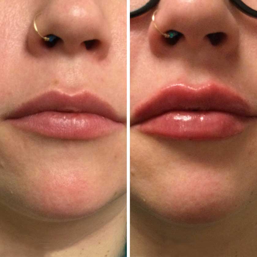 Denver Skin Care Clinic and Medical Spa Before & After Gallery Vollure Lips