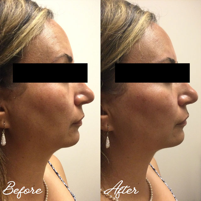 Denver Skin Care Clinic and Medical Spa Before & After Gallery Voluma Cheeks 1