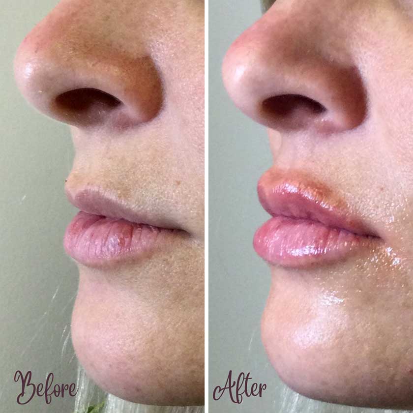 Denver Skin Care Clinic and Medical Spa Before & After Gallery juvederm before after 1