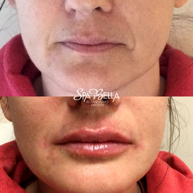 Denver Skin Care Clinic and Medical Spa Before & After Gallery Volbella Lips
