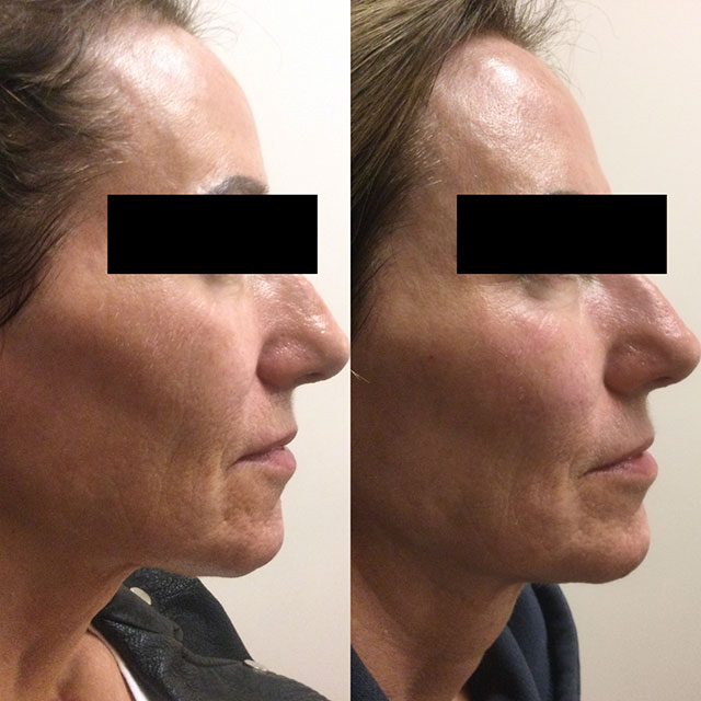 Denver Skin Care Clinic and Medical Spa Before & After Gallery Voluma Cheeks 3