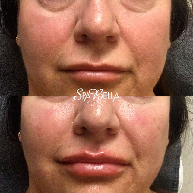 Denver Skin Care Clinic and Medical Spa Before & After Gallery Voluma and Vollure
