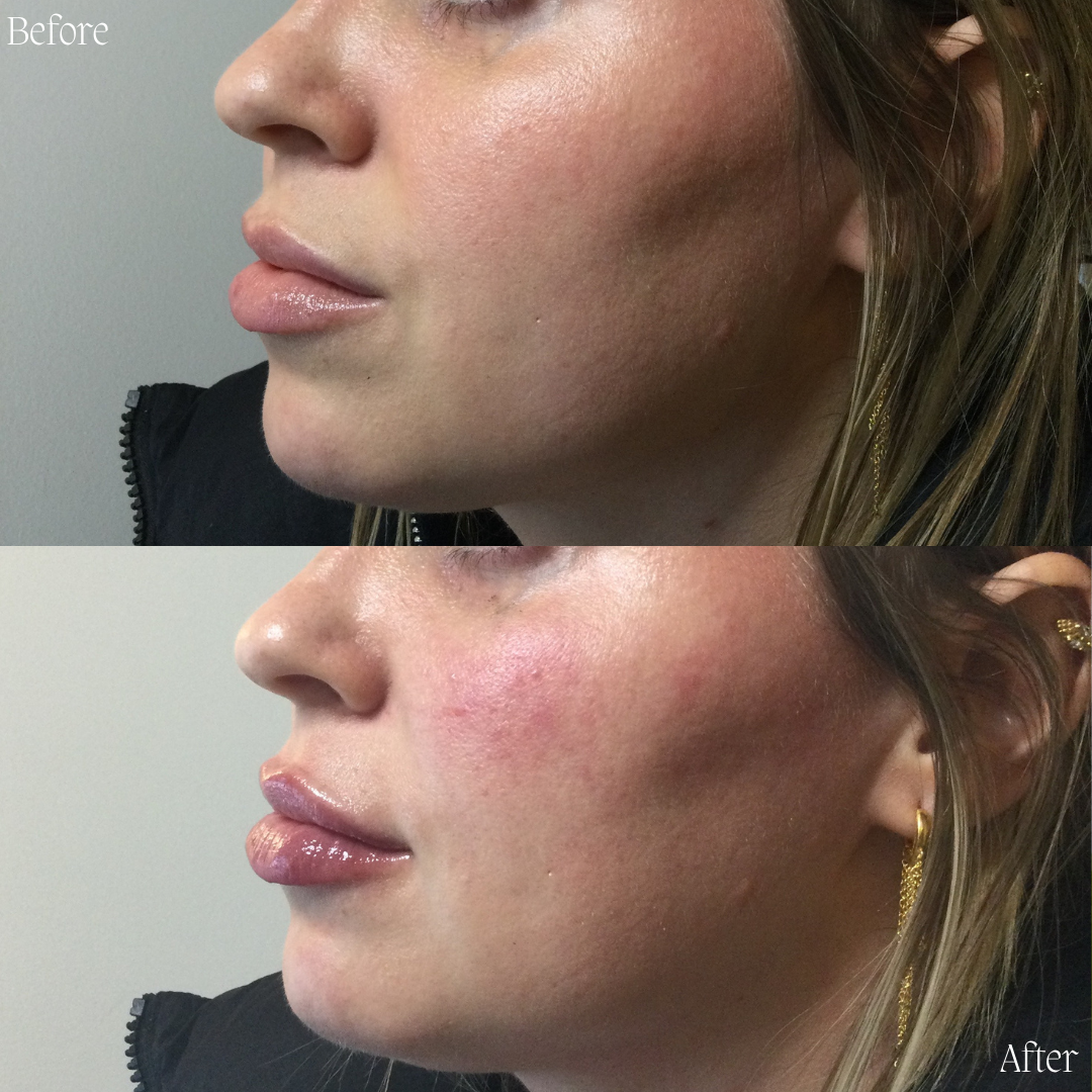 Denver Skin Care Clinic and Medical Spa Before & After Gallery Lips and Cheeks 01.19.23