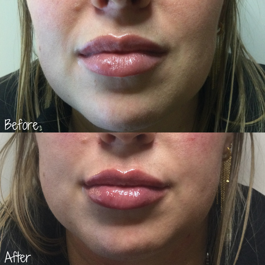 Denver Skin Care Clinic and Medical Spa Before & After Gallery Volbella Lips 01.19.23