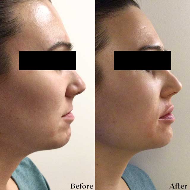 Denver Skin Care Clinic and Medical Spa Before & After Gallery vollure lips 2