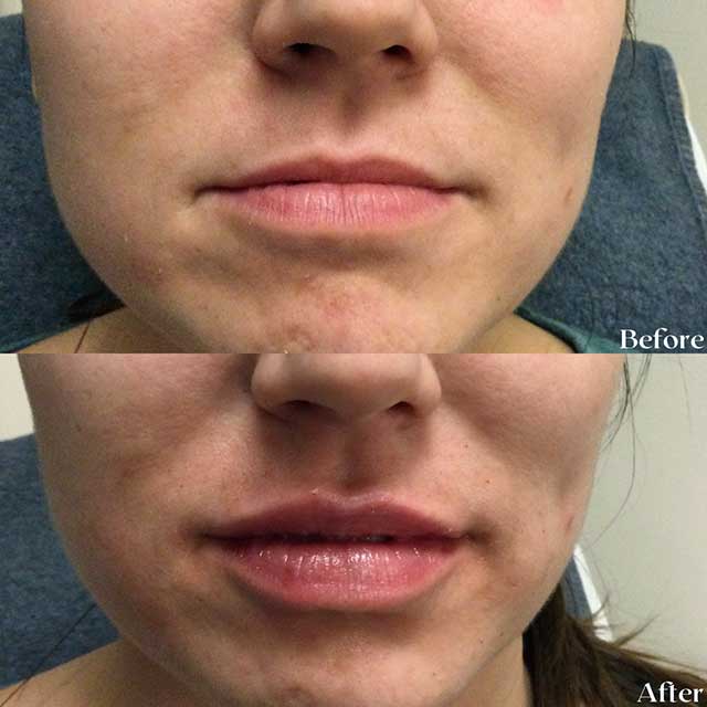 Denver Skin Care Clinic and Medical Spa Before & After Gallery vollure lips 3