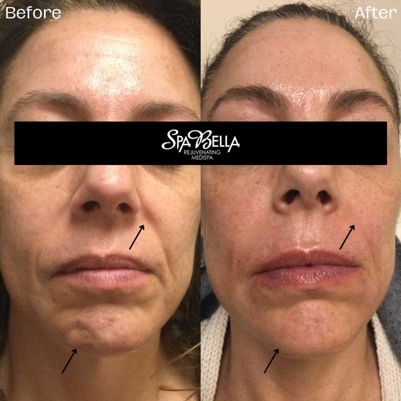 Chin Dimple and Nasolabial Fold Filler