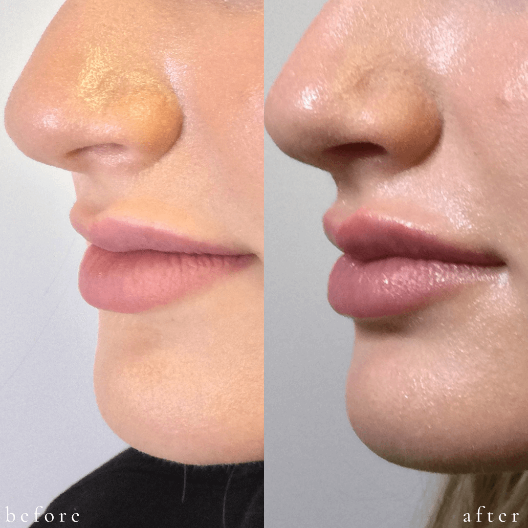 Juvederm Lips Before & After