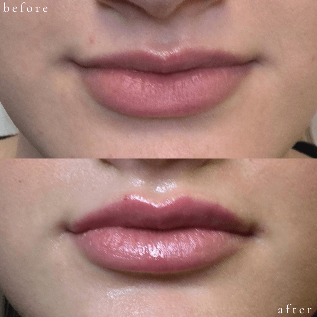 Vollure Lips Before & After