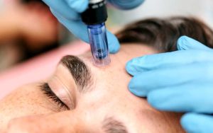 Man receiving microneedling treatment on his forehead.