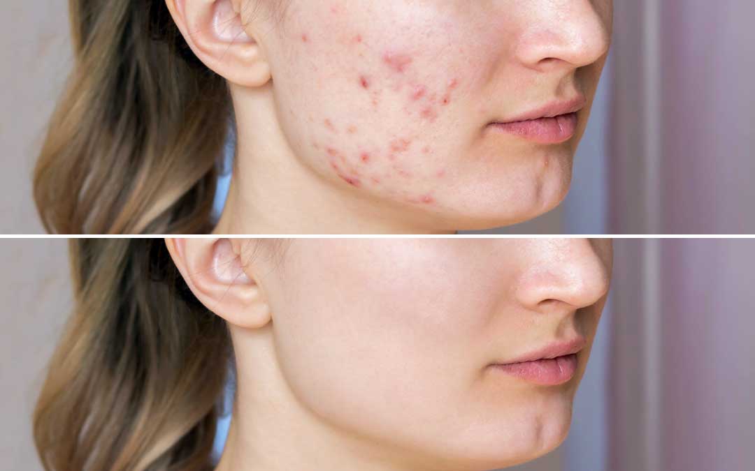 Young woman before and after acne treatment