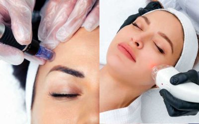 Transform Your Skin Journey with Microneedling and Laser Resurfacing