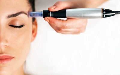 Microneedling 101: What to Expect and Why It’s a Game-Changer for Your Skin