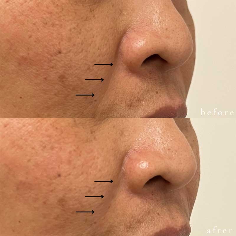 Vollure for Nasolabial Folds