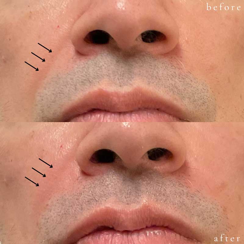 Vollure for Nasolabial Folds