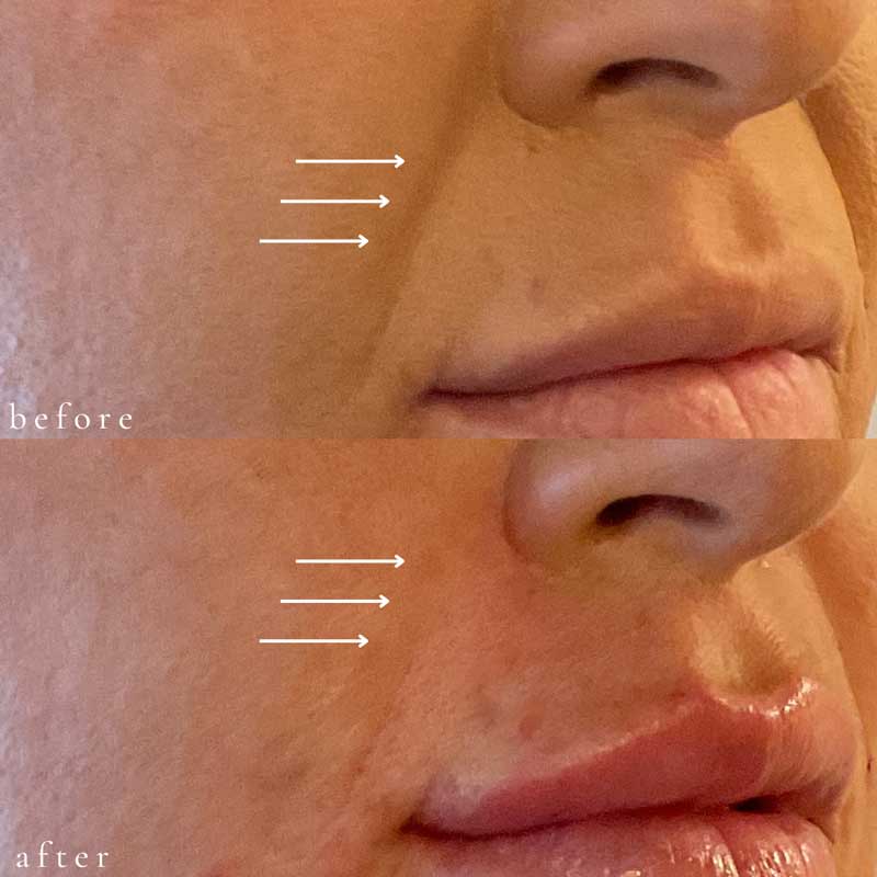 Vollure for Nasolabial Folds