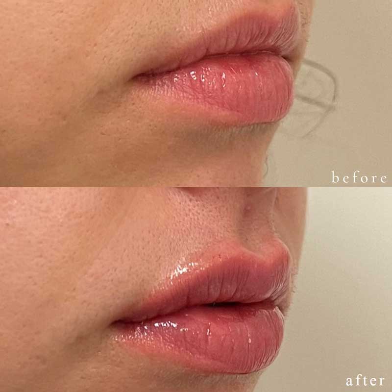 Lip Filler Before and After