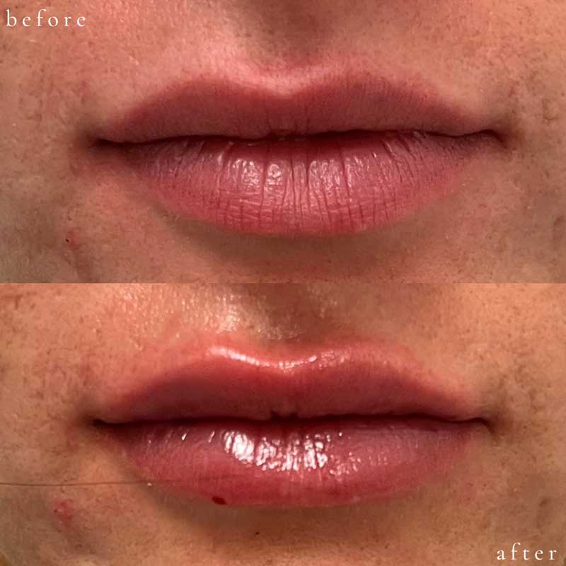 Lip Filler Before and After