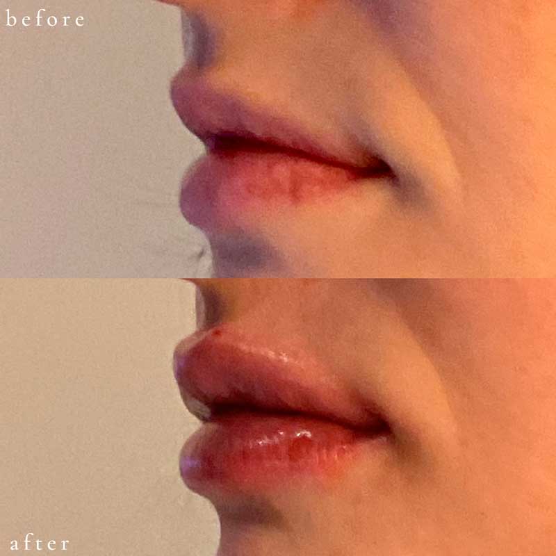 Lip Filler Before and After