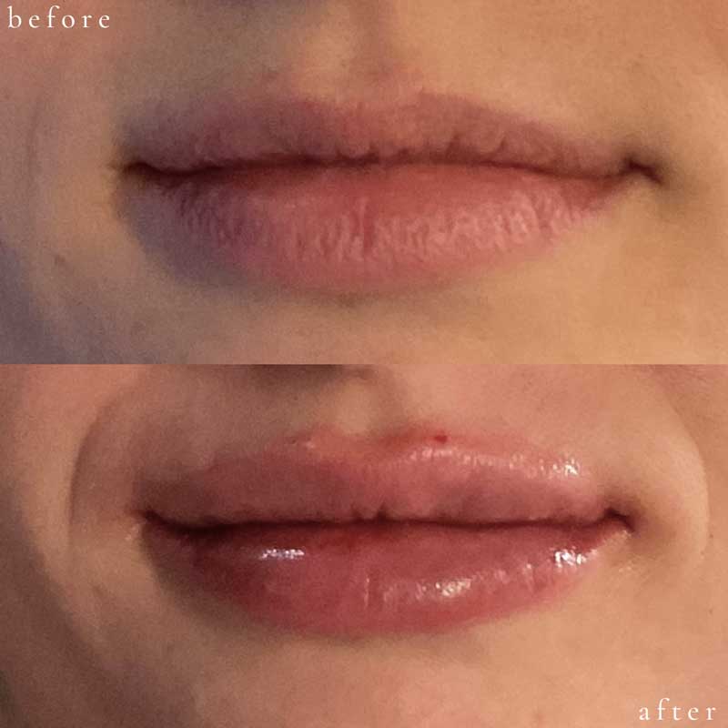 Lip Filler Before and After