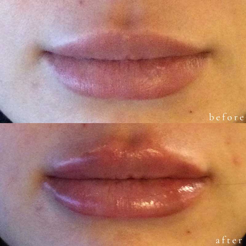 Lip Filler Before and After