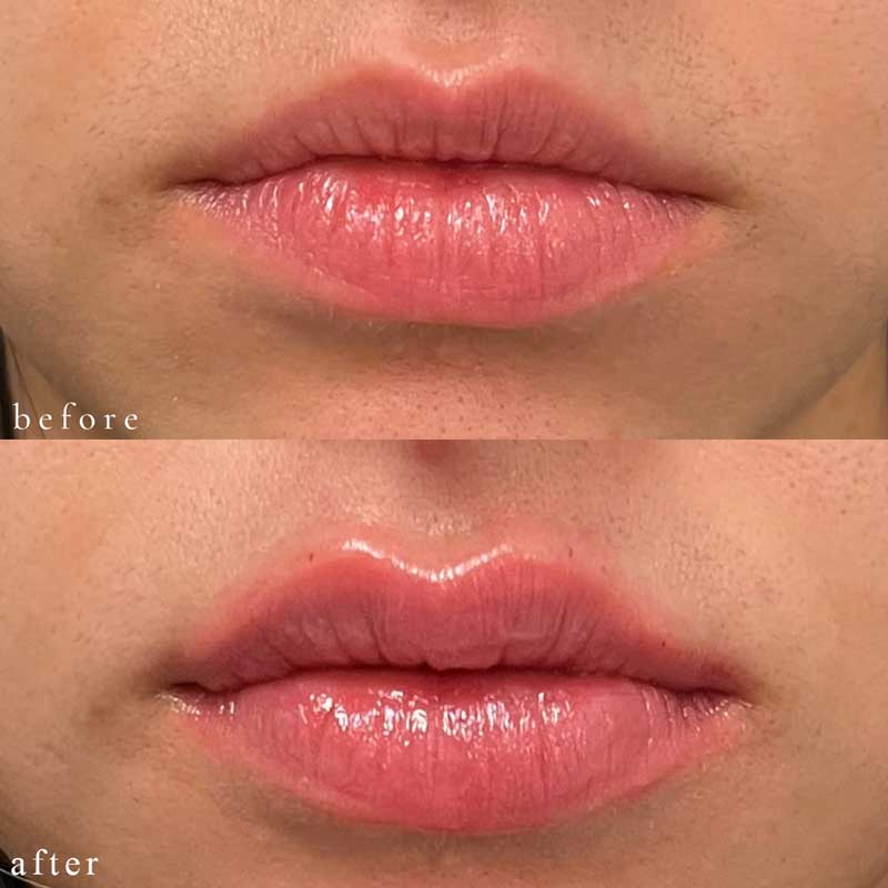 Lip Filler Before and After