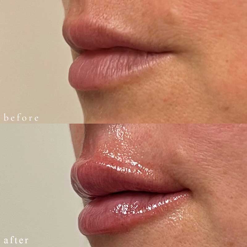 Lip Filler Before and After