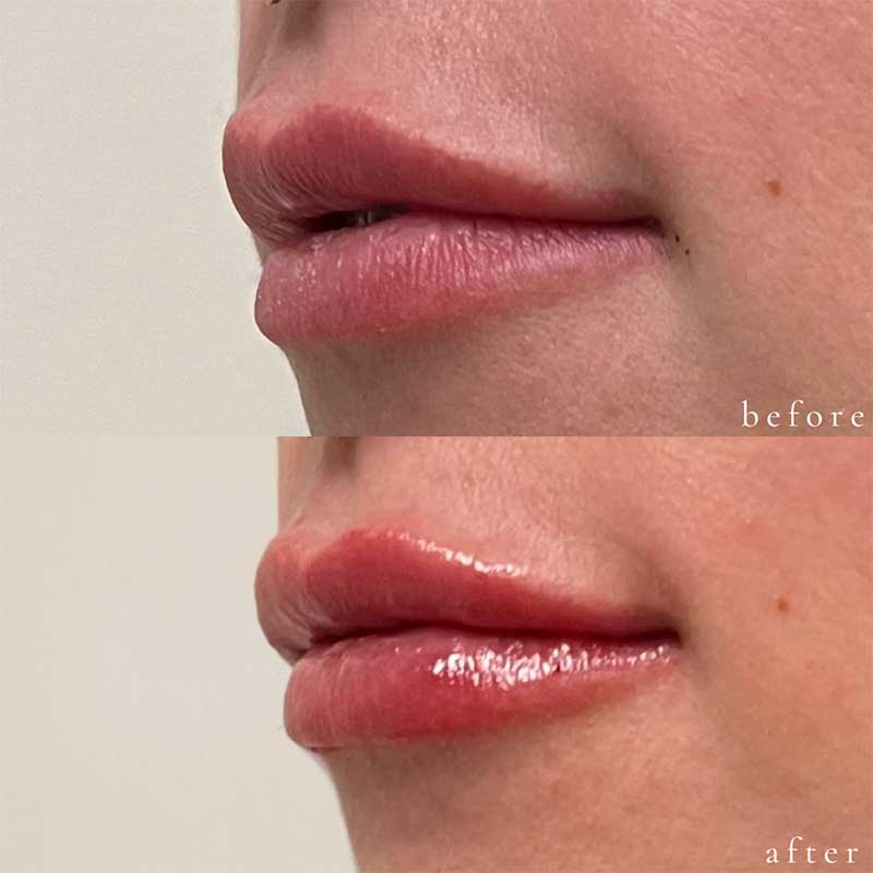 Lip Filler Before and After