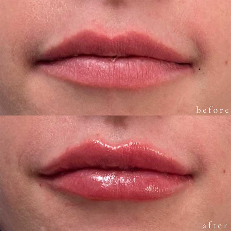 Lip Filler Before and After