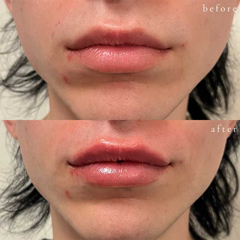 Lip Filler Before and After