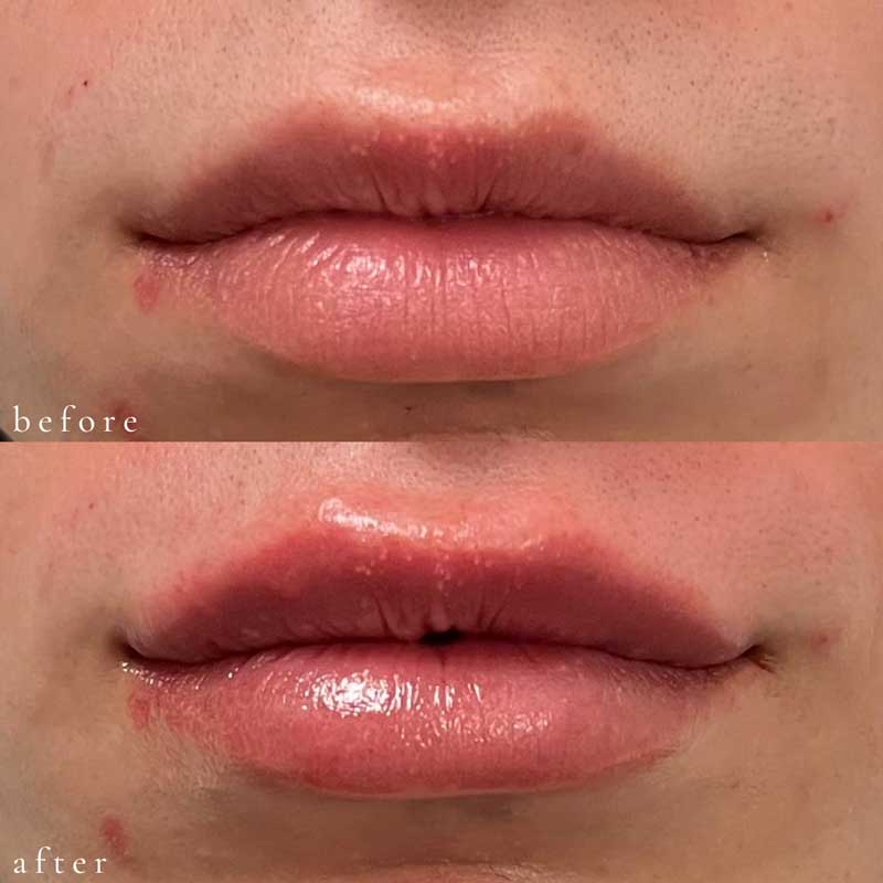 Lip Filler Before and After