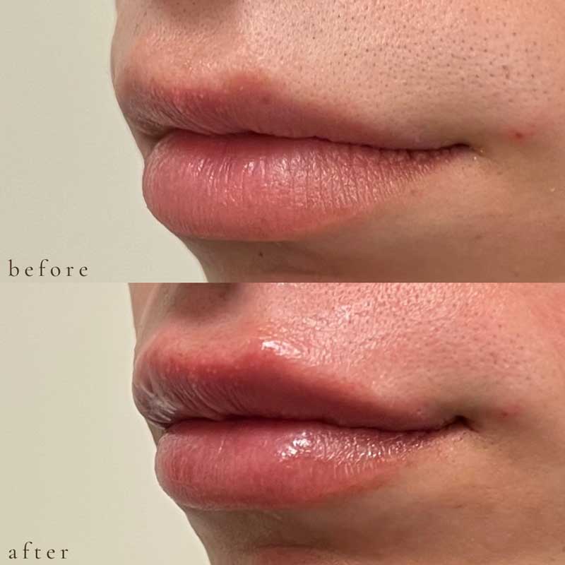 Lip Filler Before and After
